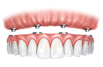 Illustration of All-On-4 Dental Implants