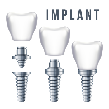 dental implants diagram