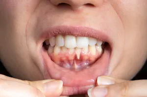 periodontal